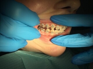 Dental treatment with braces in a clinic setting