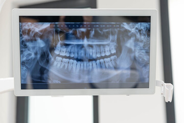 An x-ray image of teeth is shown on a screen in a dental office, helping dentists evaluate a...