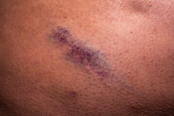 Hematoma. Bruise on leg. Closeup Bruise on body. Close up on a bruise. Gender violence concept....