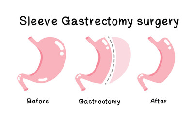 Sleeve Gastrectomy - Bariatric Surgery, on isolated white background