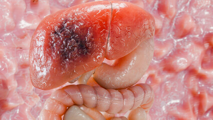 Digestive Organ Liver Cancer, Hepatitis cirrhosis malignant tumor, Hepatic failure, growing cells, duplicating, Fibrosis, Cirrhosis, Hepatocellular carcinoma, Virus infected liver, Human, 3d render