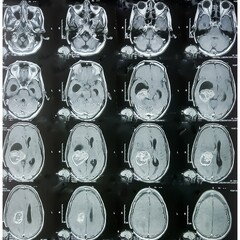 MRI scan of brain, Intraventricular hemangioma with adjoining periventricular seepages and...