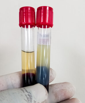 Lipemic blood sample, high Triglyceride contain serum sample. Lipemia in a blood specimen can cause significant interference with obtaining accurate test values.