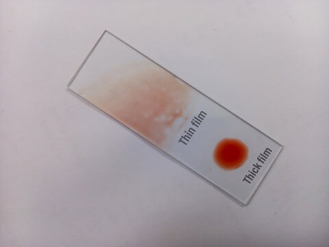 Malarial Parasite(MP) Test, to identified by examining under the microscope a drop of the patient's blood, spread out as a blood smear on a microscope slide. Thick and thin film.