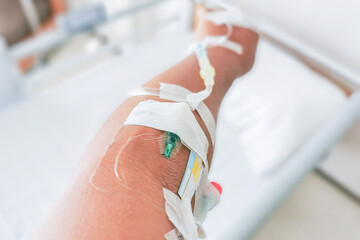 The patient's arm was punctured with a needle to receive saline and blood in the hospital.