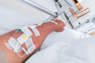The patient's arm was punctured with a needle to receive saline and blood in the hospital.
