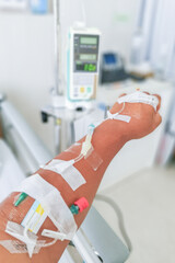 The patient's arm was punctured with a needle to receive saline and blood in the hospital.
