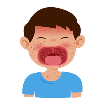 measles disease with maculopapular rash and koplik spots