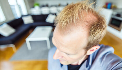 Close-up bald man male indoors, strength and recovery from alopecia. Highlights health care, dermatology, emotional resilience. Hair loss, treatment, and lifestyle changes.
