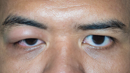 close up of adult asian man have swollen eye because of allergy