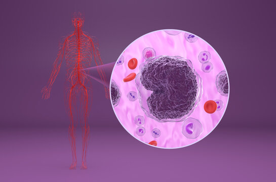 Non-hodgkin lymphoma (NHL) - isometric view 3d illustration