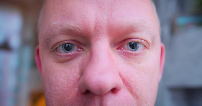 Close-up of a man eyes with dilated pupils. Pupil dilation after ophthalmologist performed a pupil dilation to examine the retina