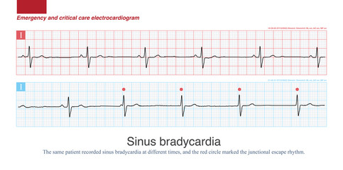 When sinus bradycardia is obvious, the ventricle can be controlled by junctional escape and ventricular escape, and escape rhythm appears.