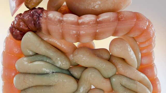 Colorectal cancer, malignant tumor in intestine, Endoscope inside colonoscopy, gut intestine, Colon polyp removal, colonic polyps search, Polypectomy, intestinal carcinoma, bowel neoplasia, 3d render
