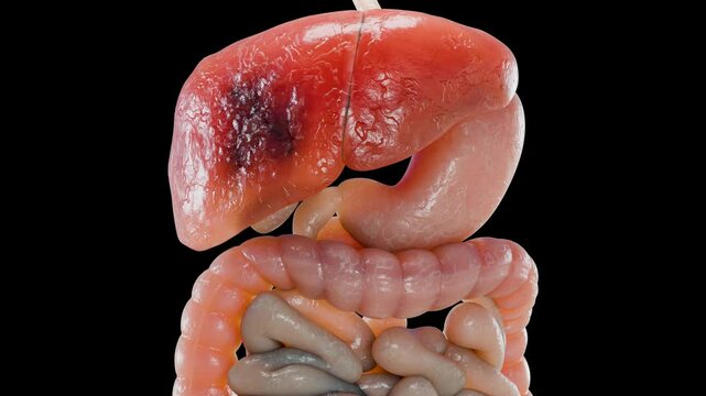 Digestive Liver Cancer, Hepatitis cirrhosis malignant tumor, Hepatic failure, growing cells, duplicating, Fibrosis, Cirrhosis, Hepatocellular carcinoma, Virus infected liver, alpha channel, 3d render