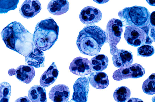 Macrophages and polymorphonuclear leukocytes
