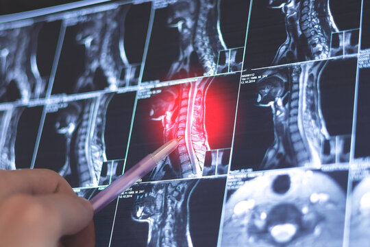 Doctor examining MRI neck spine. X-ray scan. Spondylosis of the cervical spine. Spondyloarthritis disease..Cervical spine &ndash; radiculopathy,.Neck pain, nerve root inflammation.