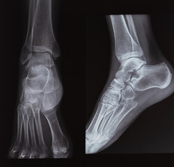 X-ray of foot fingers. Radiography.foot bones. Metatarsal, Tarsals, Phalanges bone. Treatment of Sprains and dislocations of the muscles and bones of the foot.