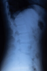 Obraz premium Close-up, medical X-ray scan of the intervertebral discs and vertebrae on the human spine. Vertical image.