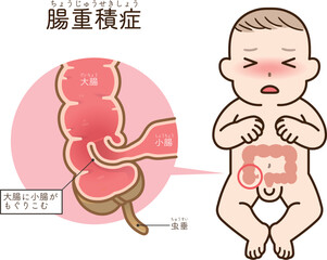 腸重積症、Intussusception、イラスト