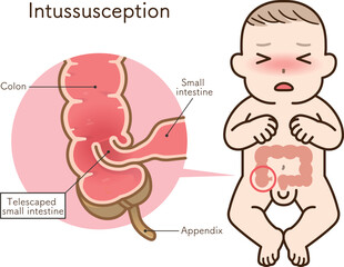 Fototapeta premium 腸重積症、Intussusception、イラスト