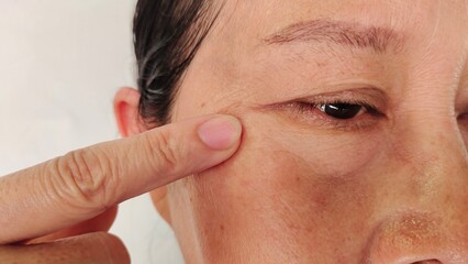 close up the fingers holding the flabbiness and ptosis beside the eyelid, dark spots and blemish, Flabby skin and loose on the face of the woman, health care and beauty concept.