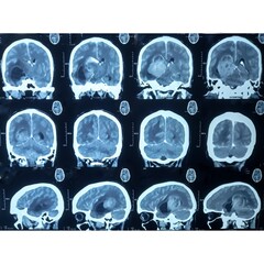 CT scan of brain, Intraventricular hemangioma with adjoining periventricular seepages and...