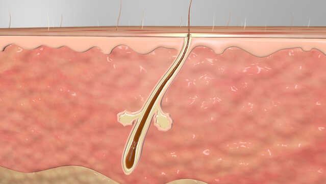 Hair Folicle Sebacious Gland Infected Pimple