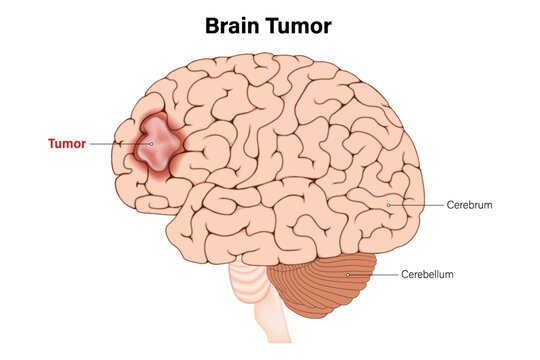 Brain tumors vector. Brain cancer. Human brain structure.