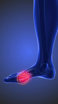 MTP joint discomfort that trigger pain