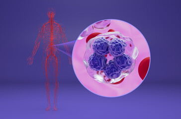 T-cell lymphoma - isometric view 3d illustration