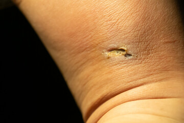 Close up of A dry, purulent wound with redness, bruising, and peeling skin on the adult foot. lesion forming wrinkle makes itchy and scratch change to scar and take time to heal, healthcare concept