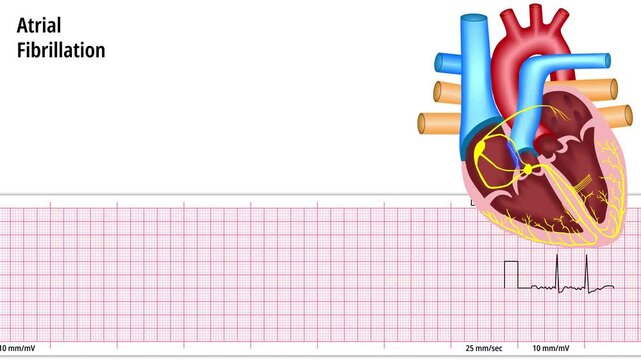 Atrial Fibrillation - ECG and Heart Conduction - Electrocardiogram Medical Animation