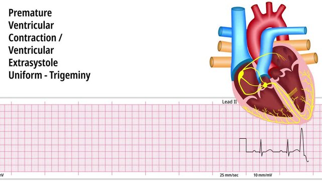 Premature Ventricular Contraction PVC - Uniform - Trigeminy - Ventricular Exstrasystole VES - ECG and Heart Conduction Electrocardiogram Medical Animation