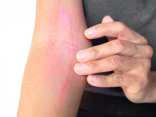 Apply calamine lotion urticaria allergy itchy rash eczema itch woman from food,air...