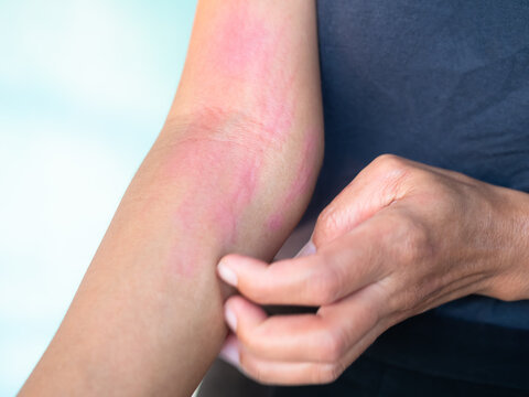 Hand with urticaria allergy itchy rash eczema itch woman from food,air poisoning,cosmetic,health,body care disease lilness air,dissease medicine calamine lotion treatment ,infection pain sick scratch.