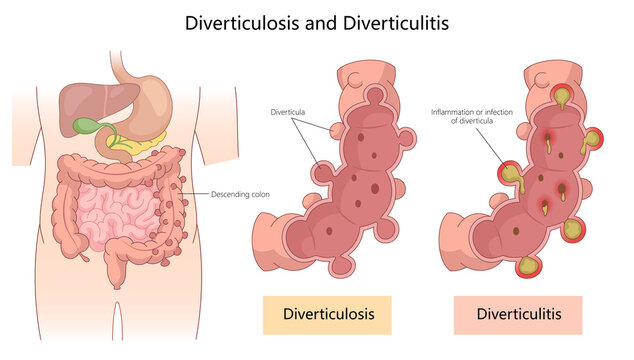 diverticulosis and diverticulitis, showing diverticula formation in the colon and inflamed or infected areas diagram hand drawn schematic raster illustration. Medical science educational illustration