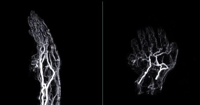 MRA of Hand with Hypothenar Mass:
A clear MRA scan of the hand reveals a strongly-enhancing vascular mass in the hypothenar area of the palm, supporting vascular diagnosis and management.