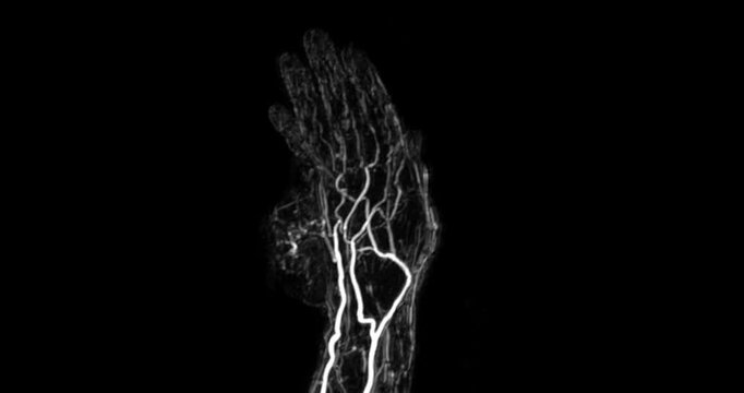 MRA of Hand with Hypothenar Mass:
A clear MRA scan of the hand reveals a strongly-enhancing vascular mass in the hypothenar area of the palm, supporting vascular diagnosis and management.