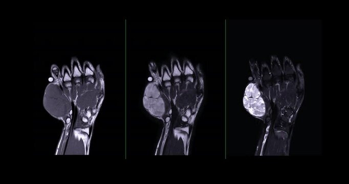 MRI Hand footage Showing Hypothenar Mass, a strongly-enhancing mass in the hypothenar region of the palm, providing detailed imaging for precise diagnosis and medical evaluation.