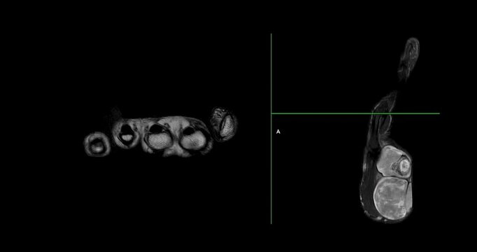 MRI Hand footage Showing Hypothenar Mass, a strongly-enhancing mass in the hypothenar region of the palm, providing detailed imaging for precise diagnosis and medical evaluation.