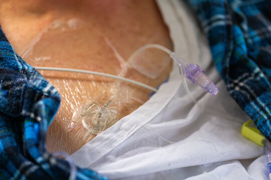 Cancer patient in hospital with portacath medical device in chest - Port-a-cath (Port)