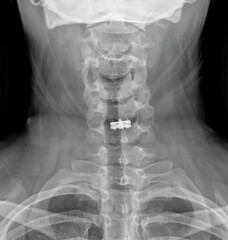 Neck X-ray of a patient undergoing Cervical Microdiscectomy and Cervical Disc Prosthesis for Medical Research and Teaching. Vector illustration. 