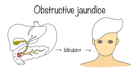 Fototapeta premium Obstructive jaundice