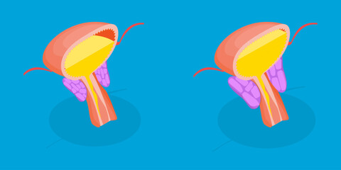 3D Isometric Flat Vector Illustration of Enlarged Prostate Gland, Benign Prostatic Hyperplasia