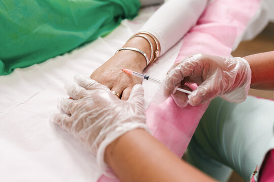 Injection Procedure for Hand Rejuvenation