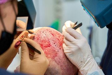 Close-up of surgeons performing a hair transplant procedure, showing the detailed process of...