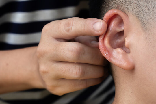 Parent&rsquo;s hand applying treatment cream on son&rsquo;s ear who illness with inflamed skin from Atopic dermatitis. Selective focus at antihelix and scaphoid fossa of earlobe.