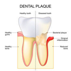 Dental plaque. Gingival inflammation. Close-up of a Tooth