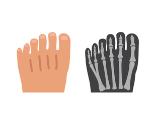 Human polydactyly. 6 toe external and internal view on x-ray. Medical chart.